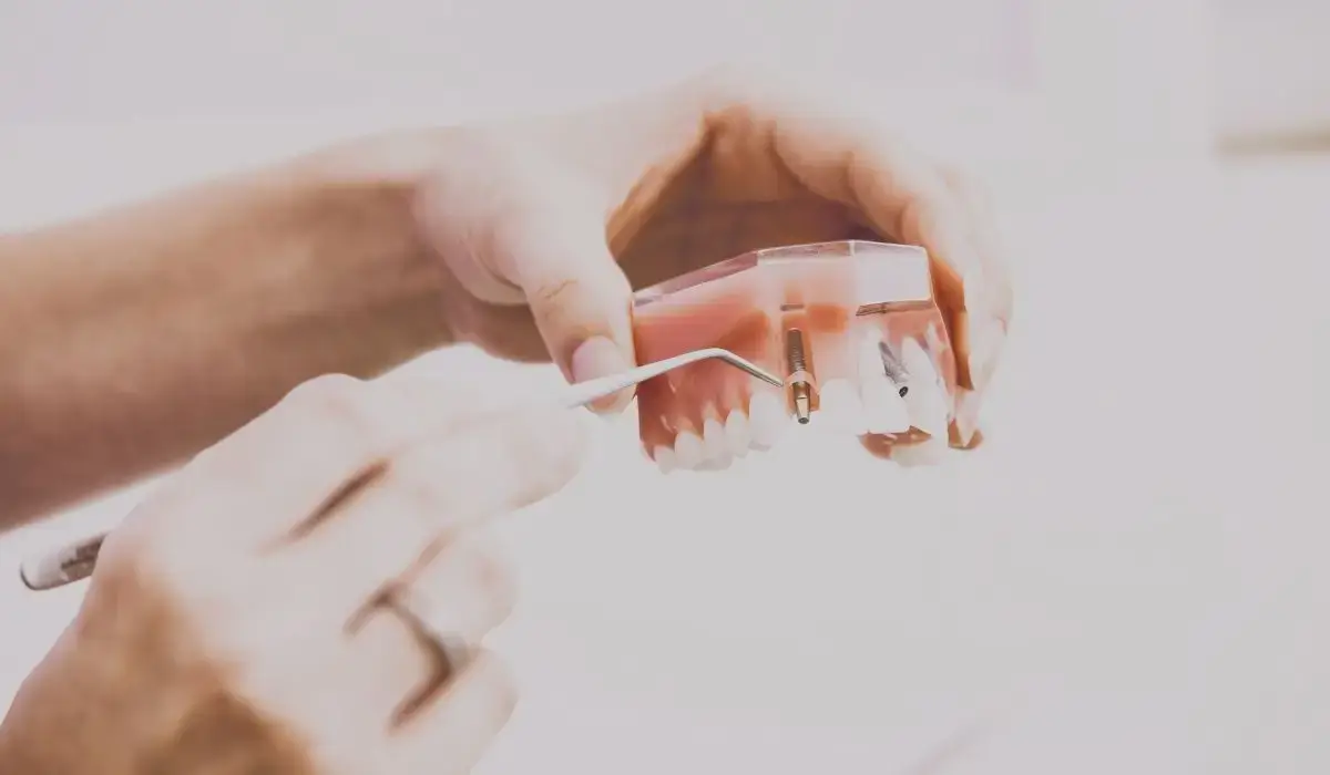 Dental model demonstrating implant-supported dental bridge placement.